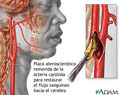 Endarterectoma